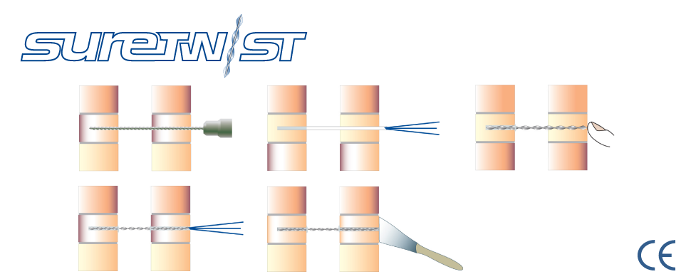 SureTwist - Resin Remedial Wall Tie